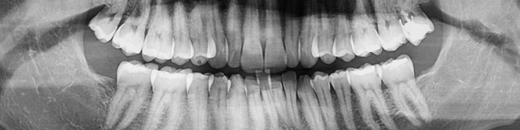 当院の歯周病治療