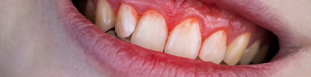 基本治療の限界を超える「精密歯周外科治療」