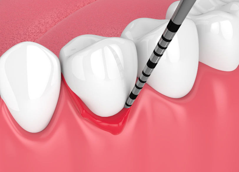 歯周ポケット検査｜いばた歯科