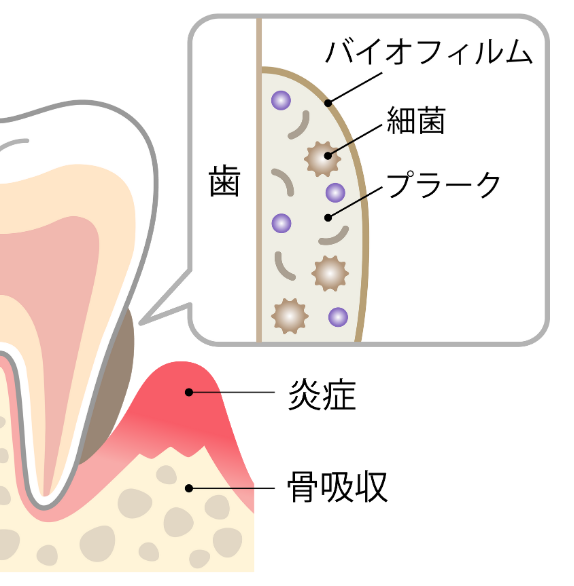バイオフィルム｜いばた歯科