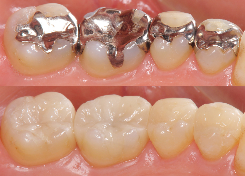 デジタル審美セラミック治療｜いばた歯科