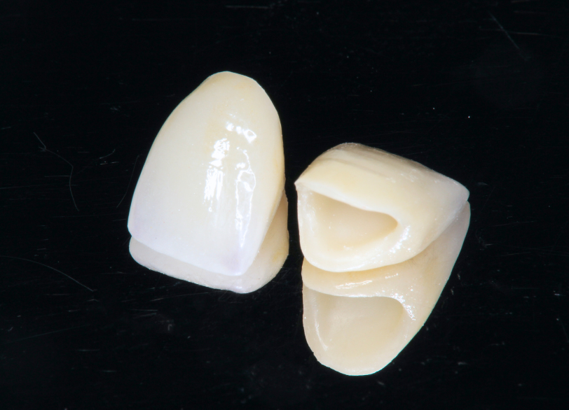 ガラスセラミック｜いばた歯科