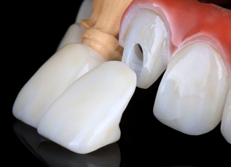 ハイブリッドセラミック｜いばた歯科