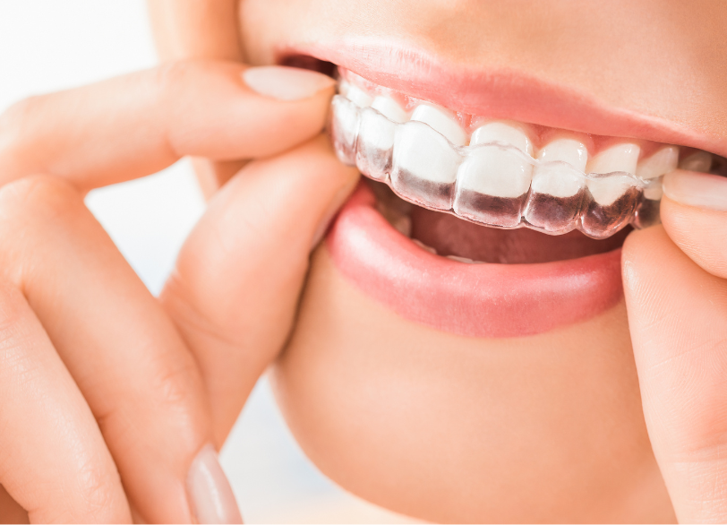 オーダーメイドのマウスピース製作｜いばた歯科