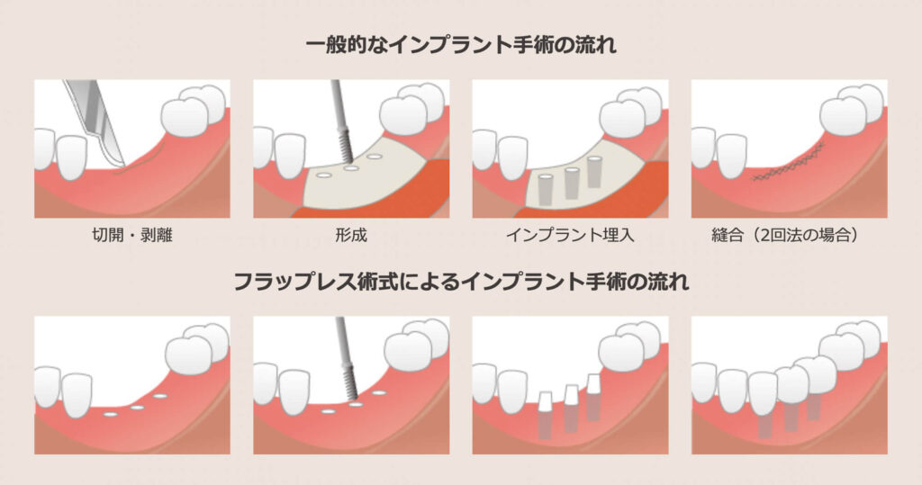 フラップレス手術｜いばた歯科