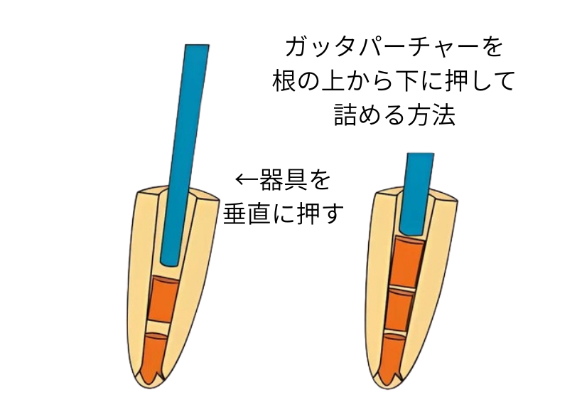垂直加圧充填法（システムB）｜いばた歯科