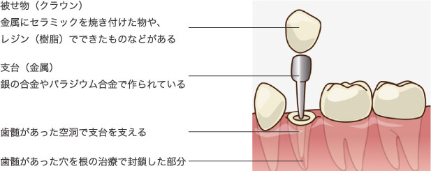 i-TFCシステム（根築一回法）｜いばた歯科