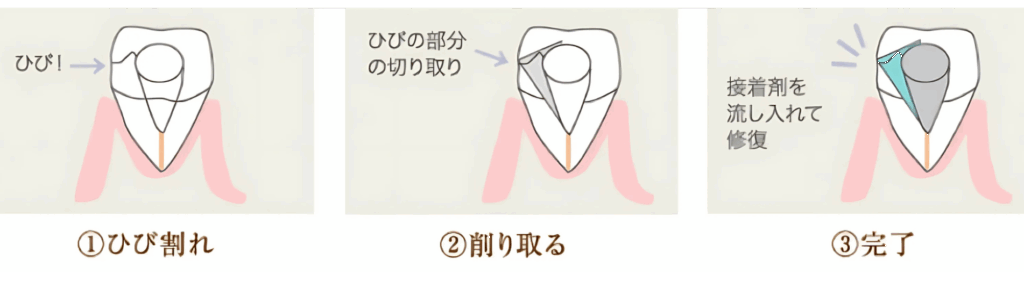 口腔内接着法｜いばた歯科