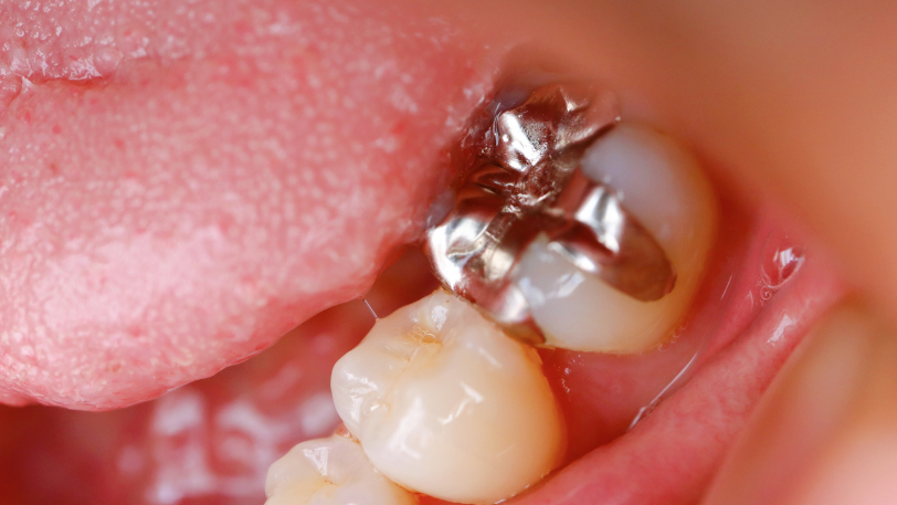 銀歯の問題点｜いばた歯科