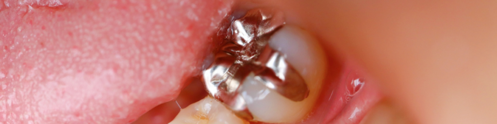 当院が「銀歯」を使わない理由