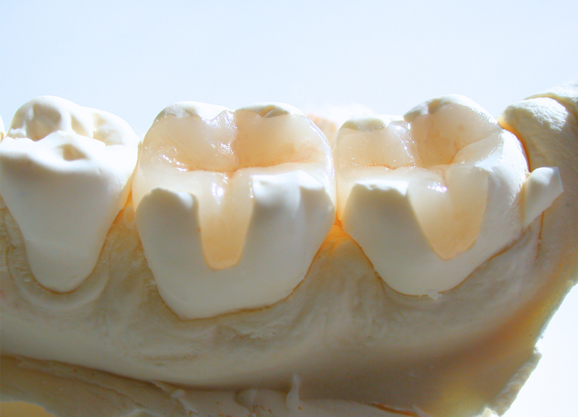 デジタルセラミック修復｜いばた歯科