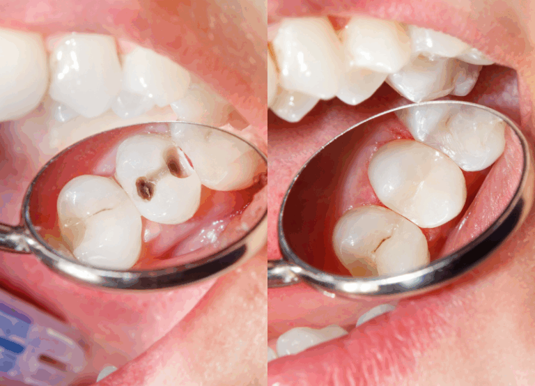 ダイレクトボンディング｜いばた歯科