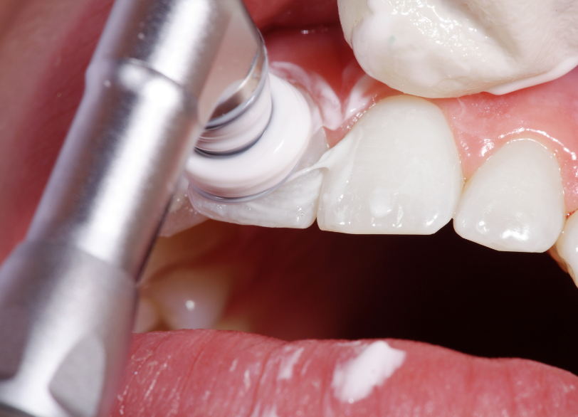 PMTC｜いばた歯科