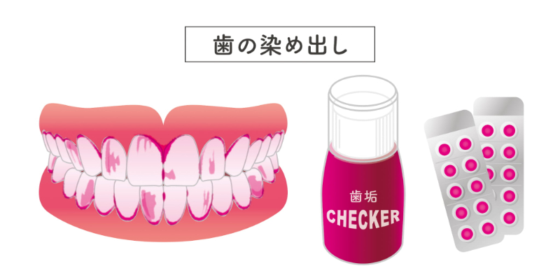 ブラッシング指導で行う歯の染め出しの手順イメージ
