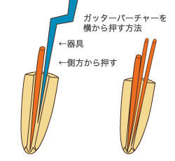 側方加圧法（そくほうかあつほう）