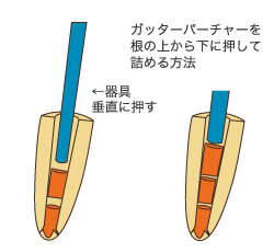 垂直加圧法（すいちょくかあつほう）
