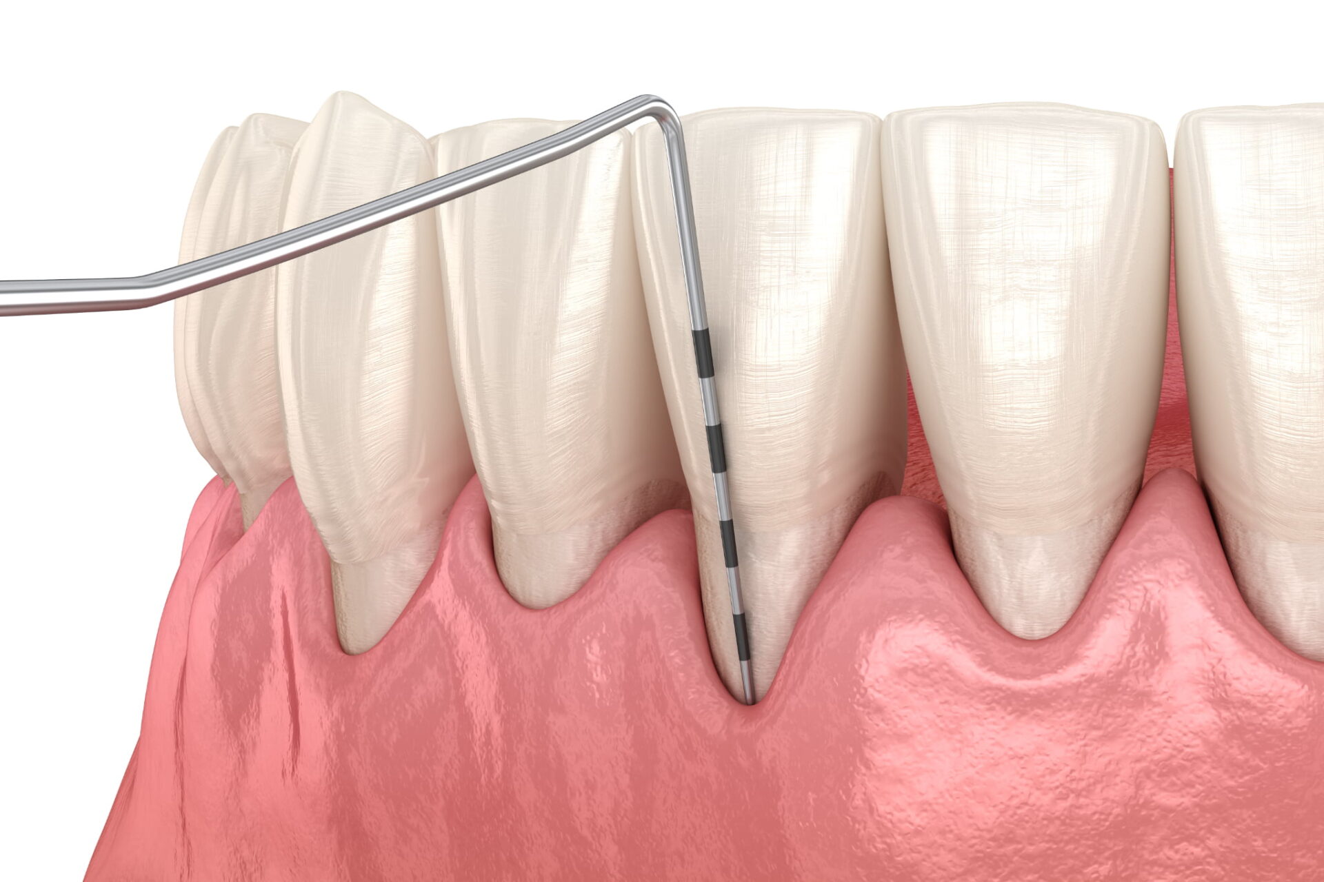 歯周病の進行段階と症状を説明するイメージ
