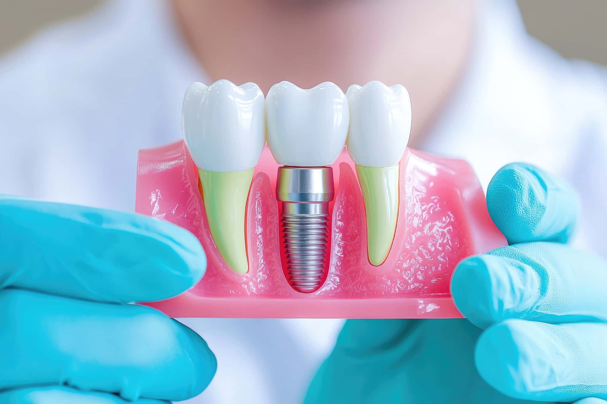 インプラントについて説明するイメージ