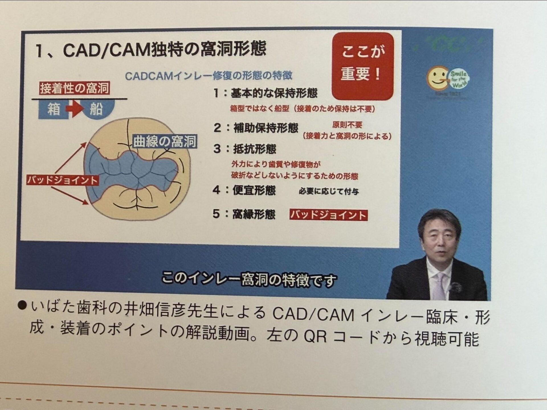 CAD/CAMインレー治療についての解説動画の説明