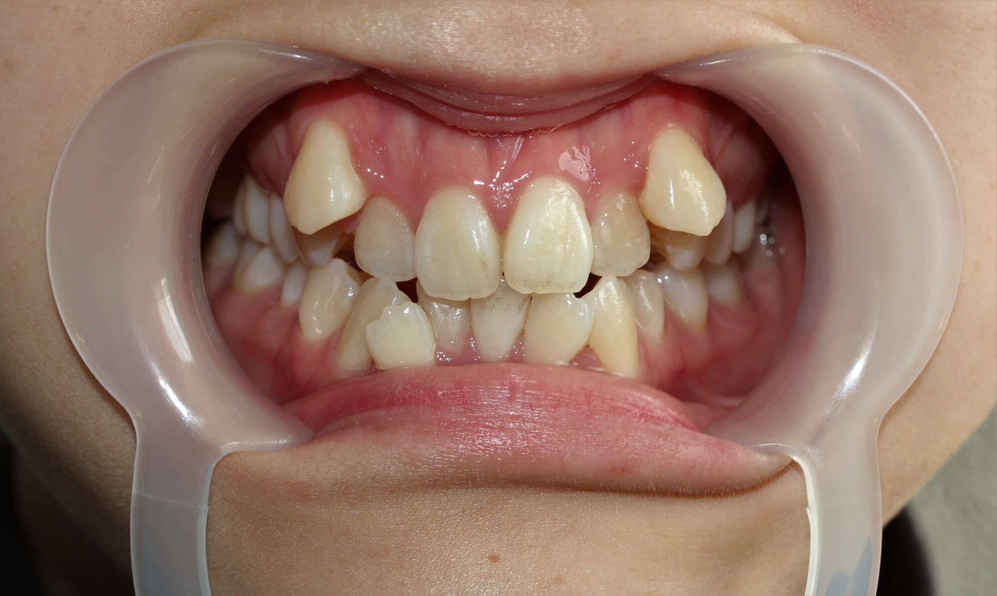 八重歯が目立つ歯並び