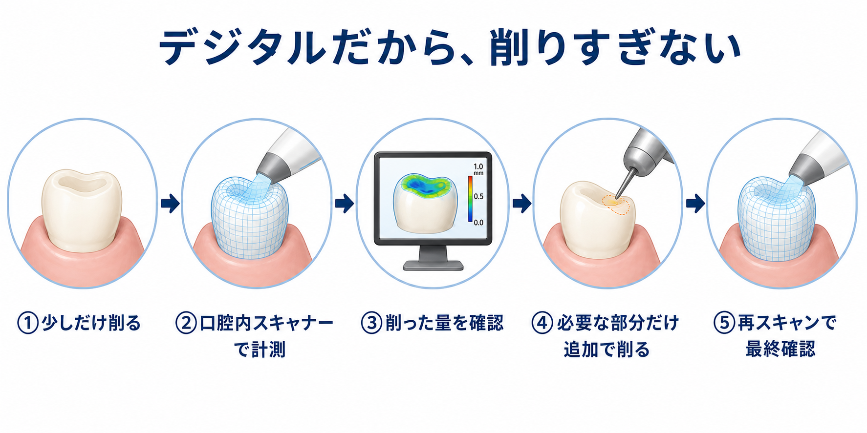 口腔内スキャナーを使い、少しずつ削って計測を繰り返すデジタル治療の5つの工程を示した図