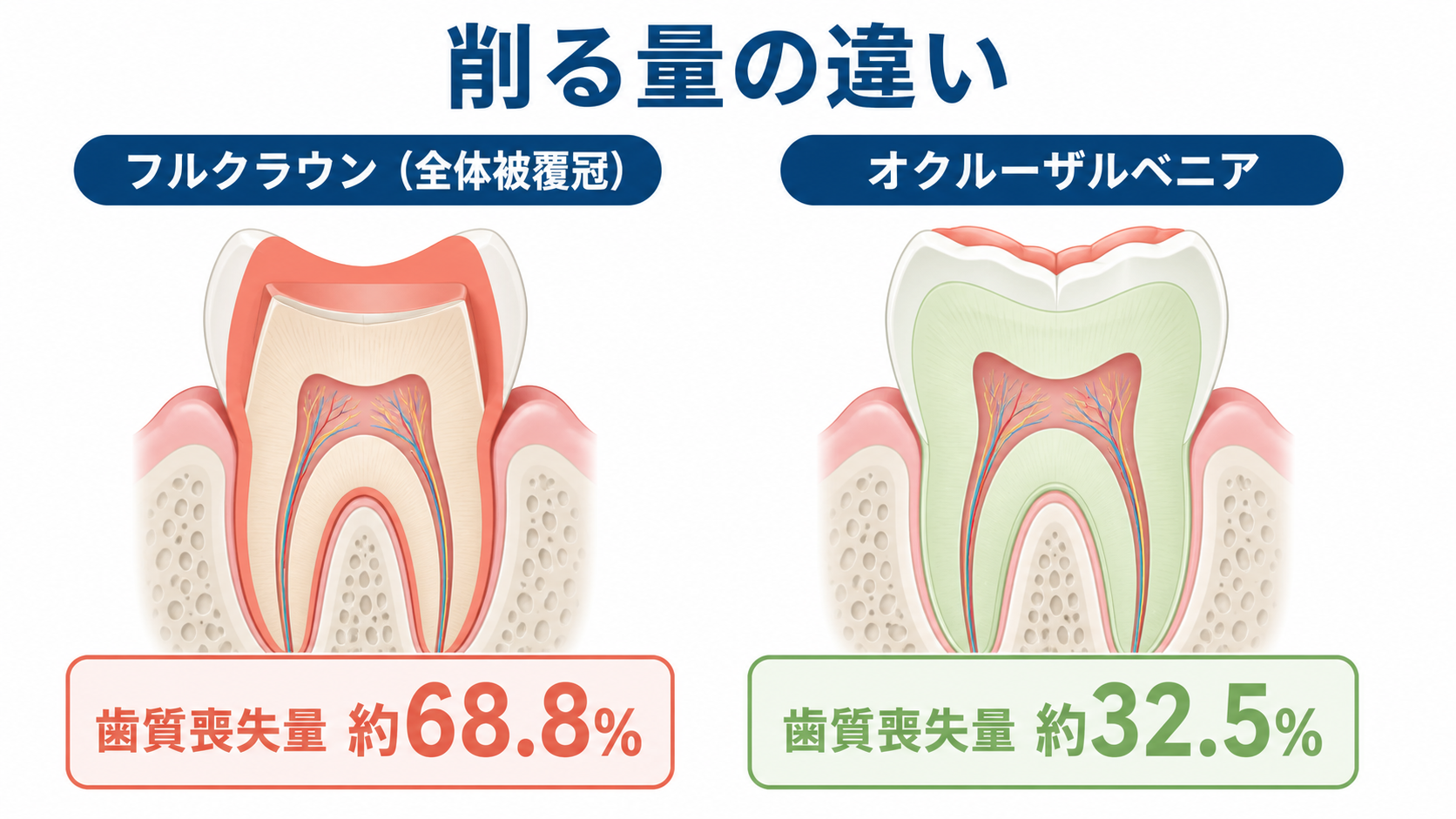 フルクラウンとオクルーザルベニアで削る量を比較した奥歯の断面図。歯質喪失量は約68.8%と約32.5%