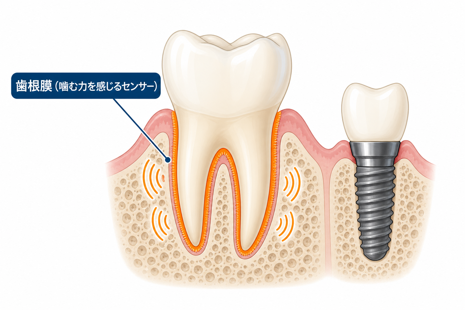 天然歯の歯根膜とインプラントの構造を比較した断面図。天然歯にある歯根膜が噛む力を感じるセンサーとして働くことを示している