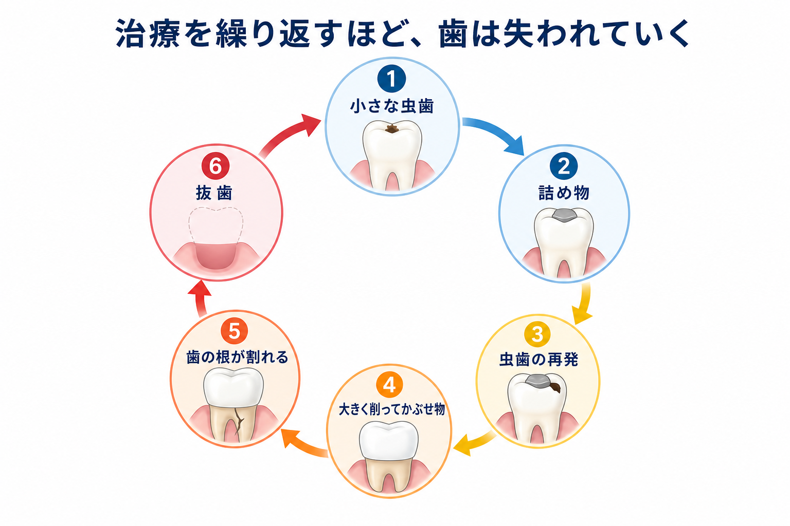虫歯の治療を繰り返すことで、詰め物から抜歯へと進んでいく流れを示した図